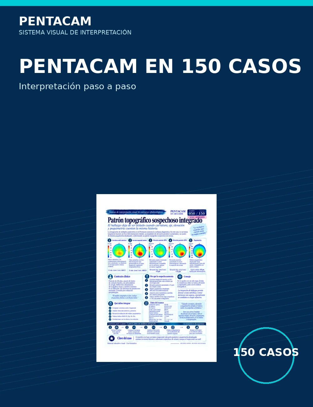 Pentacam en 150 Casos